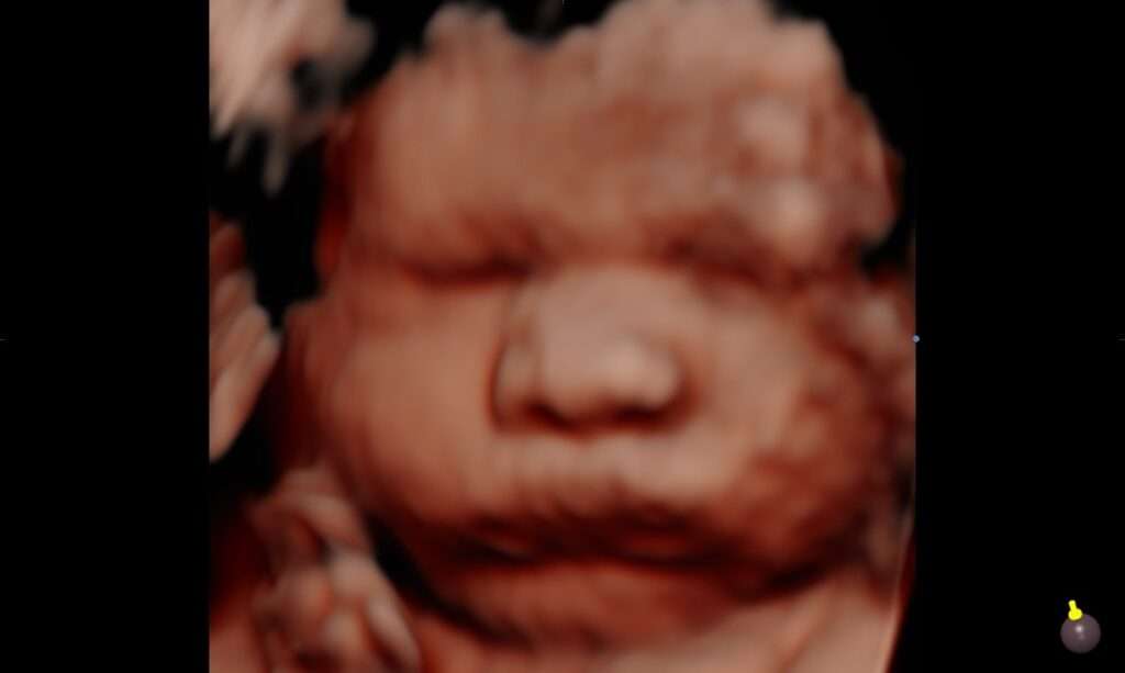 5D Ultrasound of 3rd trimester baby