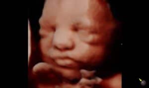 5D ultrasound of baby with eyes open