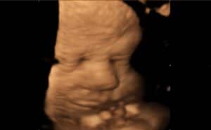 3D Ultrasound of Baby's Face done at Peeping Moms Ultrasound