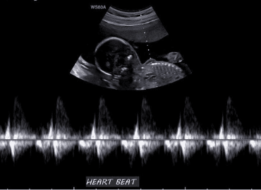 Doppler waveform of baby's heartbeat on 2D Ultrasound