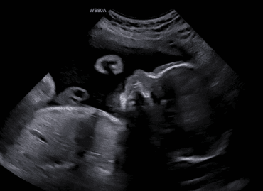 3rd Trimester Baby Profile on 2D Ultrasound
