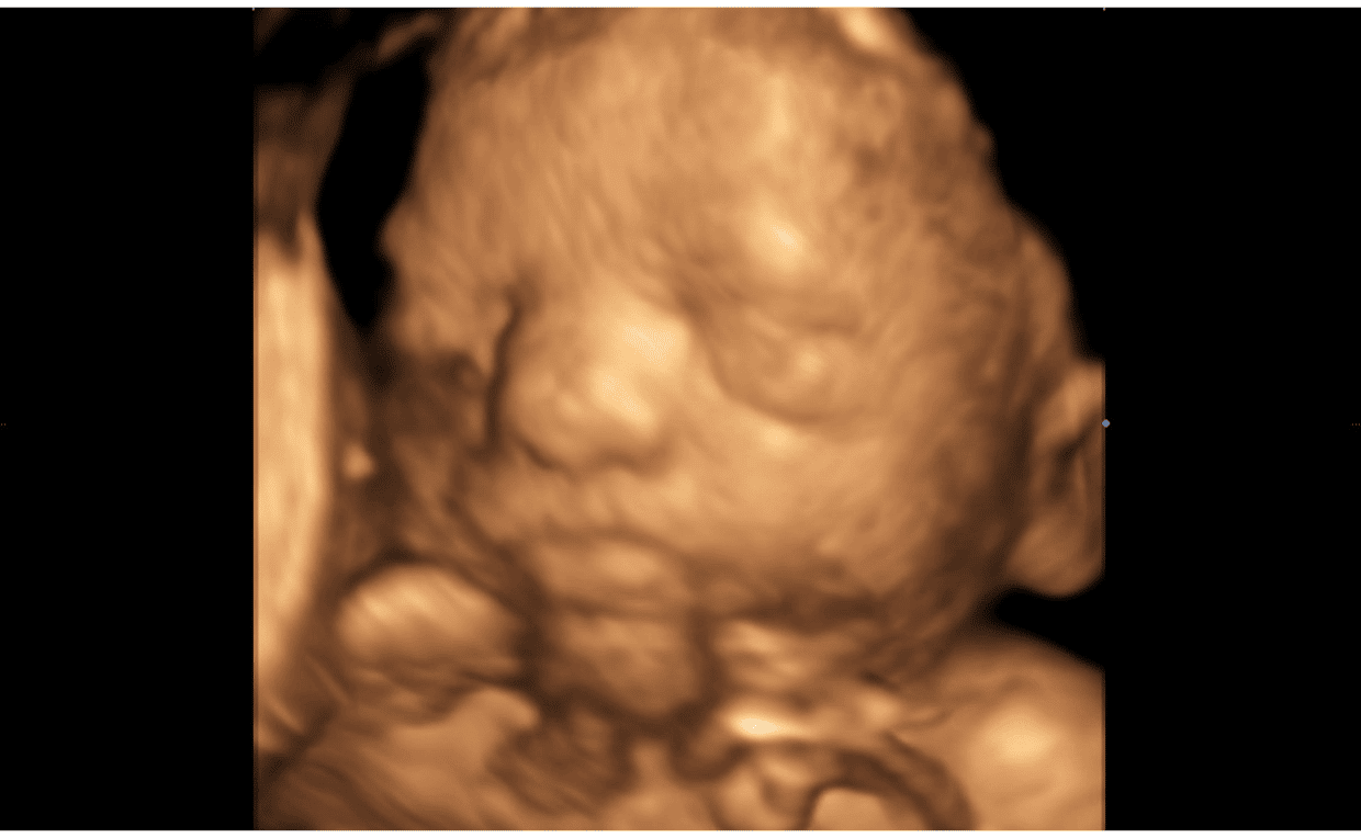 3D Ultrasound image of baby's face