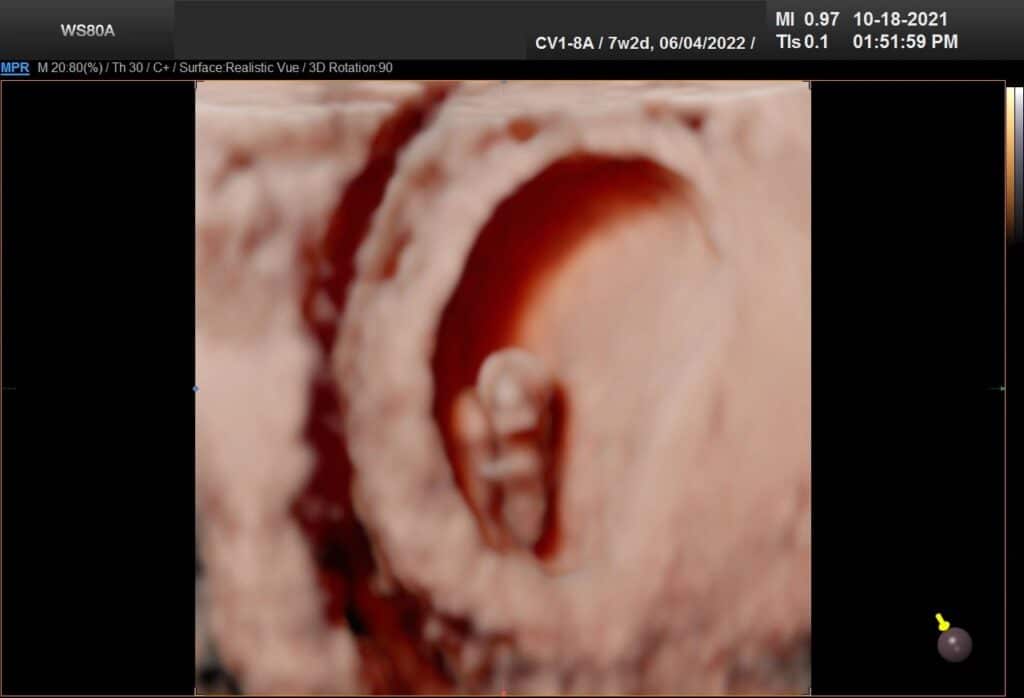 1st trimester 5D ultrasound image