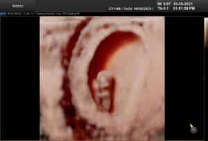 5D Ultrasound image of a 1st trimester pregnancy