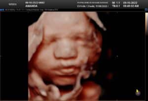 3rd trimester 5D ultrasound of baby's face