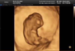 3D Ultrasound of 1st trimester fetus