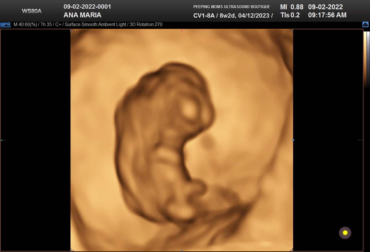 3D Ultrasound of 1st trimester fetus