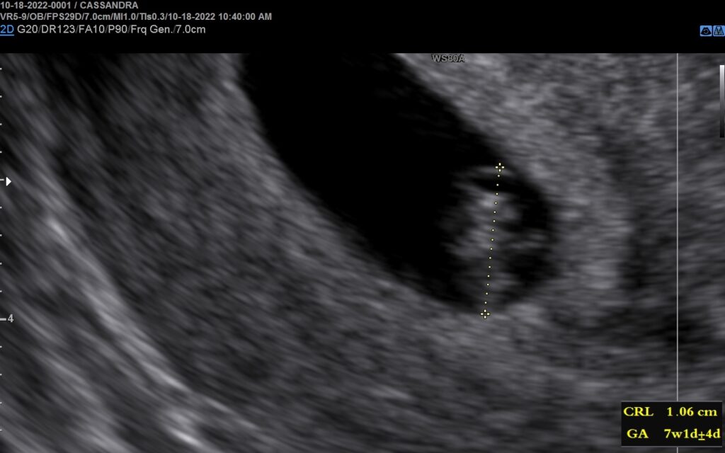 7 weeks pregnant ultrasound report