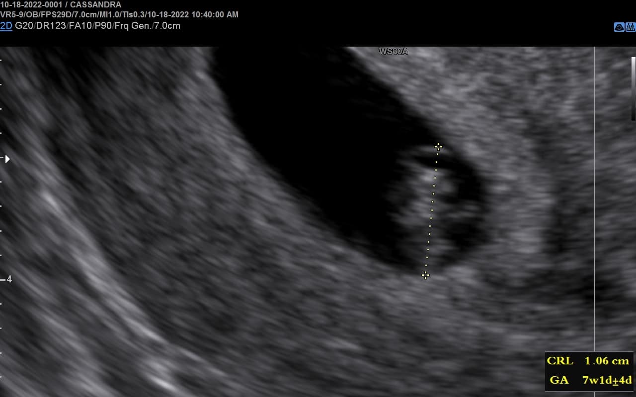 Rhombencephalon seen on 7 week fetus