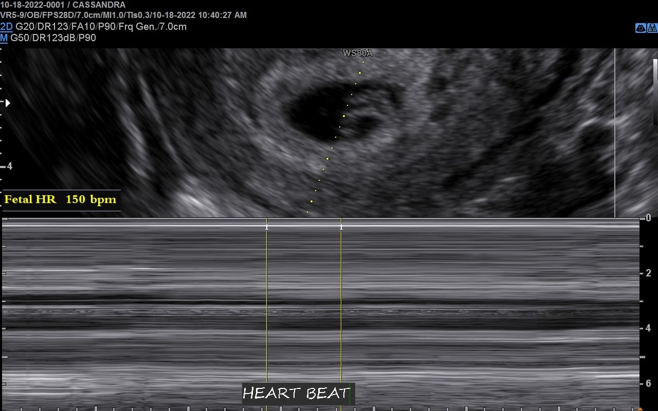 M-Mode measuring out 1st trimester fetus