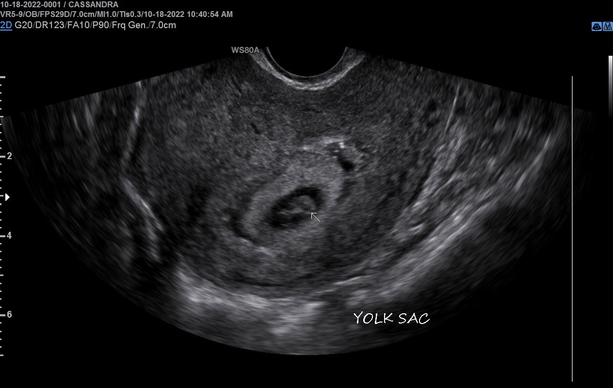 Yolk Sac in 7 Week Gestation