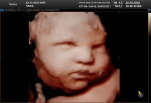 3rd Trimester baby with eyes open on 5D ultrasound image