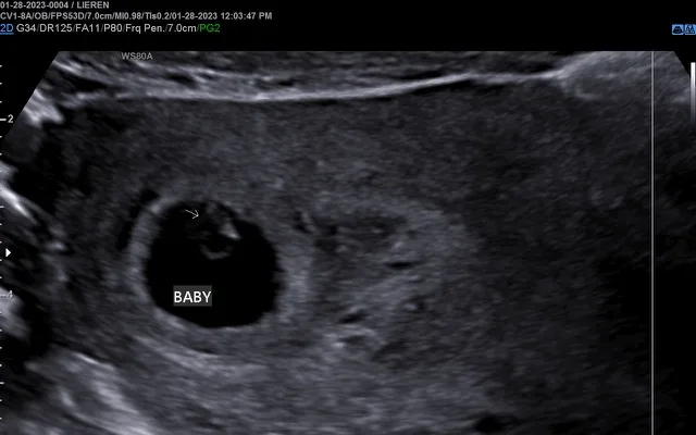 6 week pregnancy 2D ultrasound showing fetal pole (baby), yolk sac & gestational sac