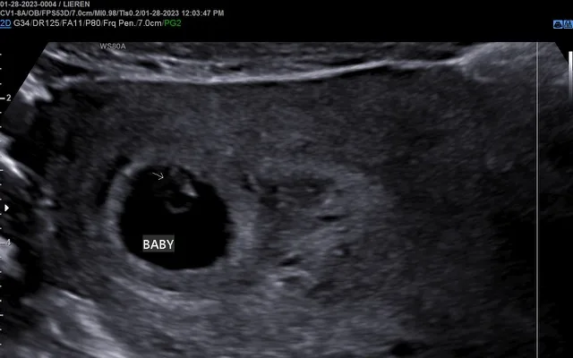 6-week-ultrasound-archives-peeping-moms-ultrasound-boutique