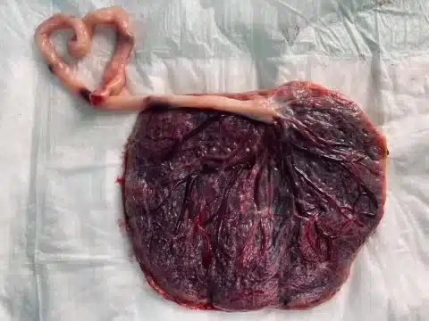 Placenta with Umbilical Cord shaped into a heart