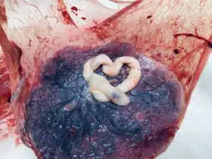 Placenta with Amnion Attached