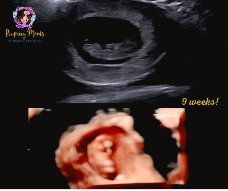 9 weeks pregnant ultrasound no heartbeat