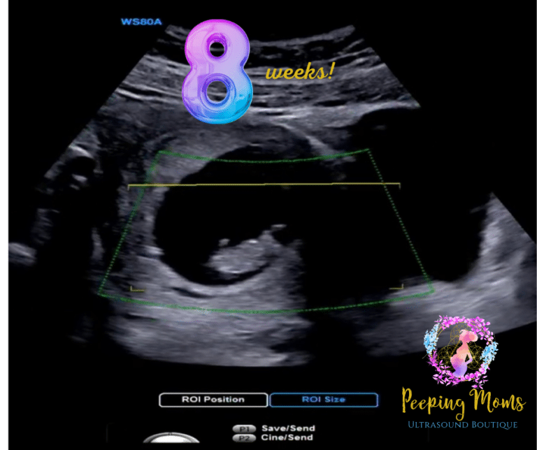 8 weeks pregnant ultrasound report